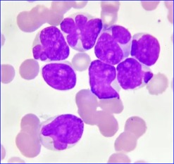 Targeting RAS proteins may prevent relapse in Acute Myeloid Leukemia