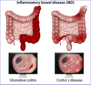 Researchers identify new major cause of inflammatory bowel disease