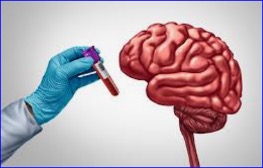 Tau Blood Test Flags Preclinical Alzheimer's Disease