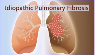 Zinpentraxin alfa comparable to placebo in idiopathic pulmonary fibrosis