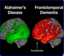 Psilera receives positive preclinical in vivo data for frontotemporal dementia (FTD) candidate, PSIL-006